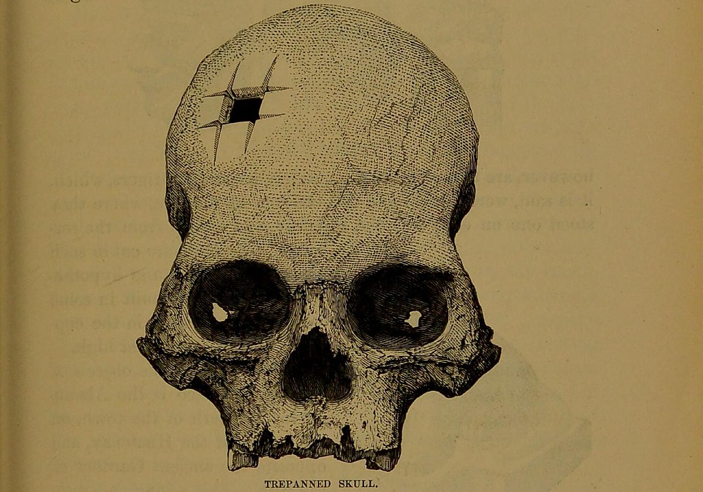 O crânio com perfuração quadrada que confirmou que os incas realizavam cirurgias complexas