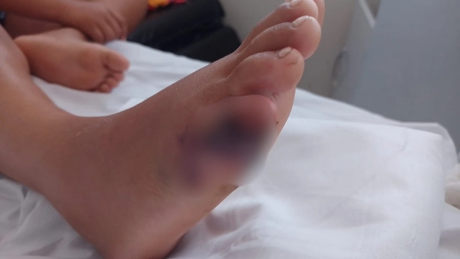 Crianças são mutiladas em brinquedo de condomínio em Camaçari